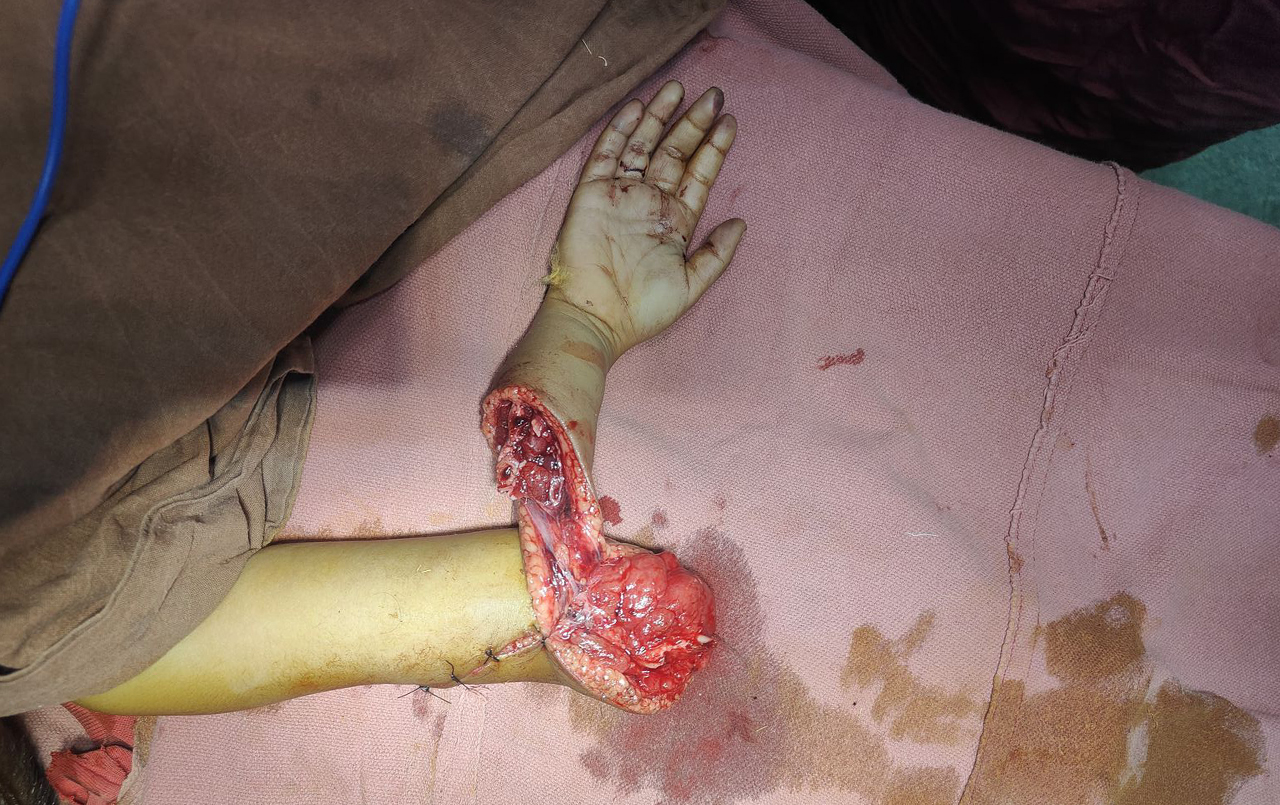 Breast Implant Surgery