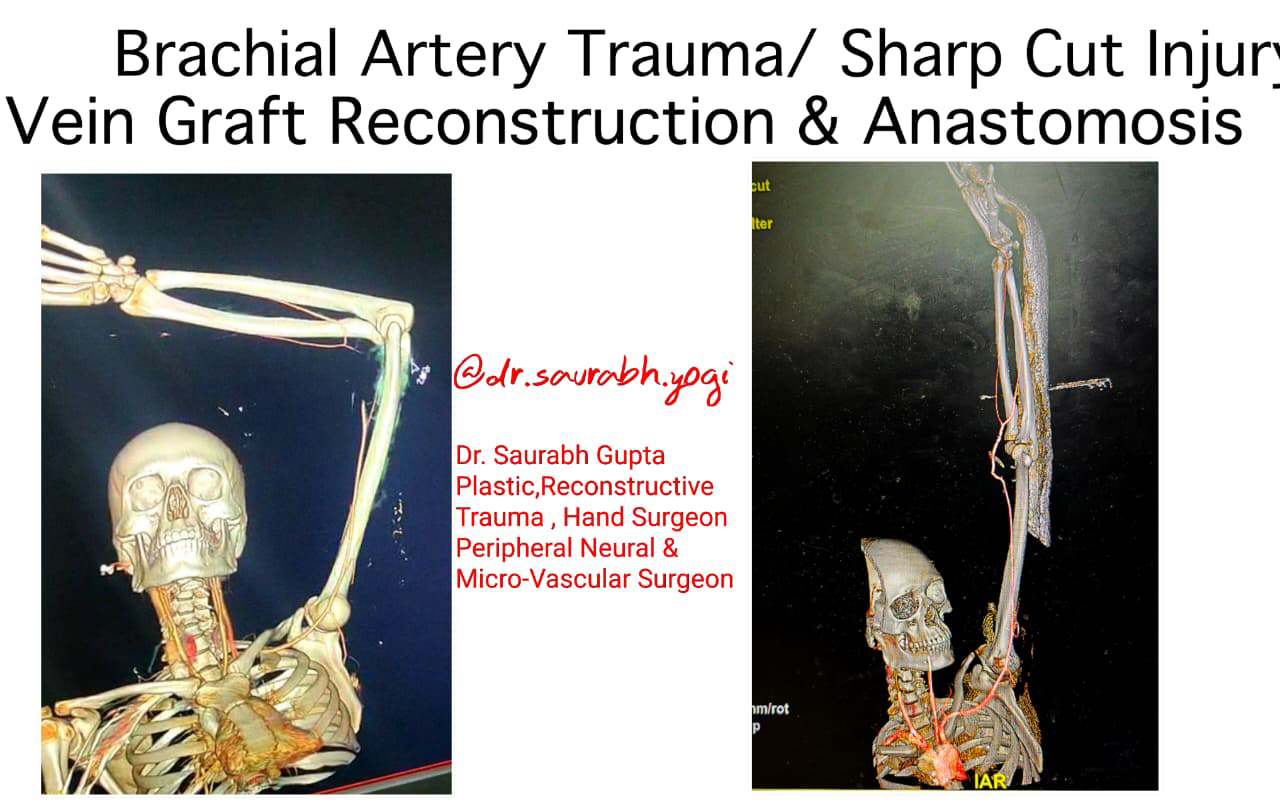 Breast Implant Surgery