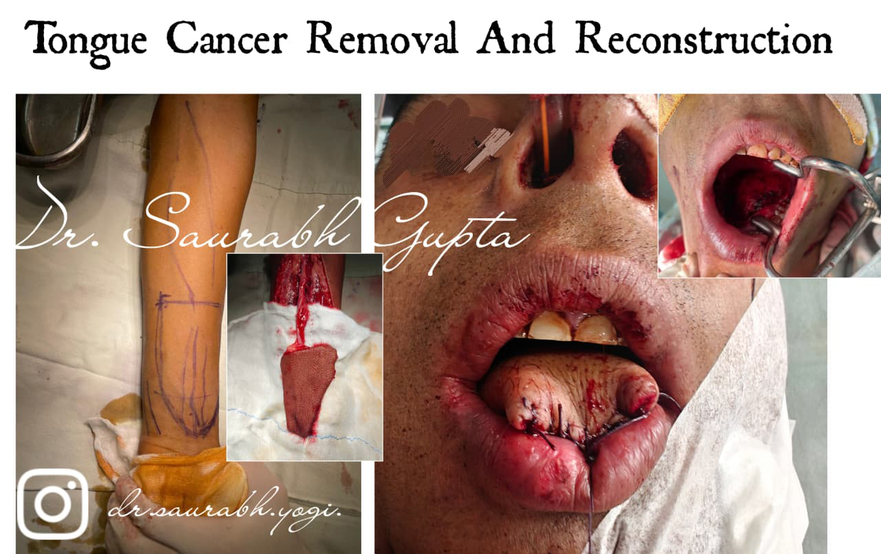 Breast Implant Surgery