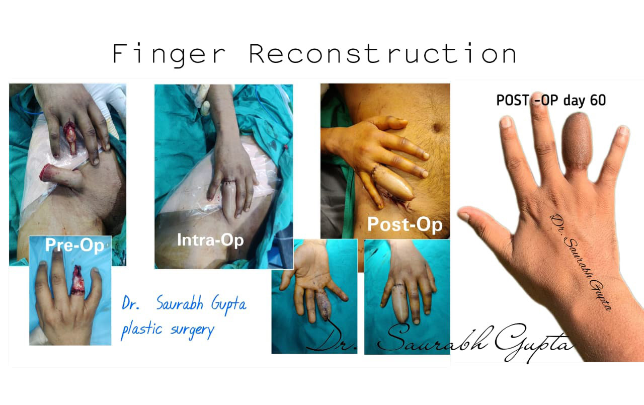 Breast Implant Surgery