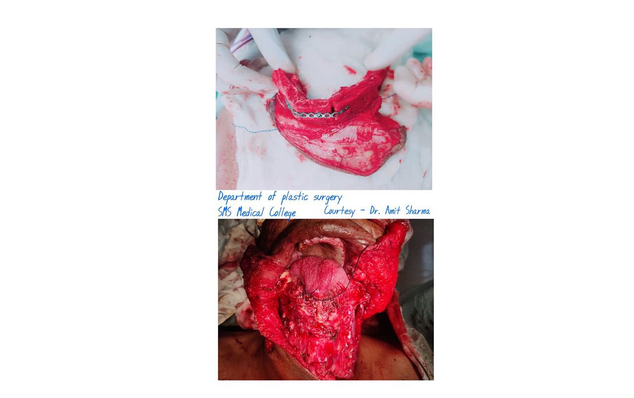 Breast Implant Surgery