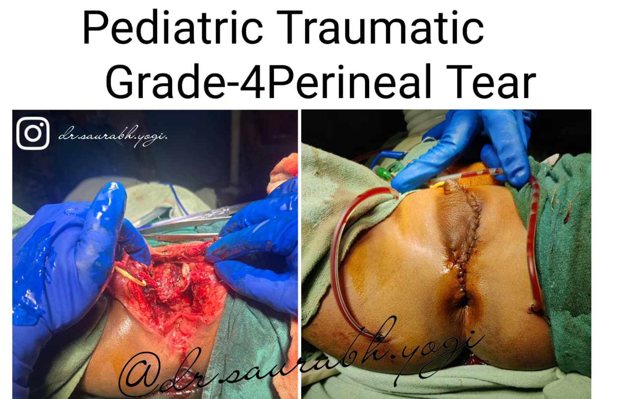 Breast Implant Surgery