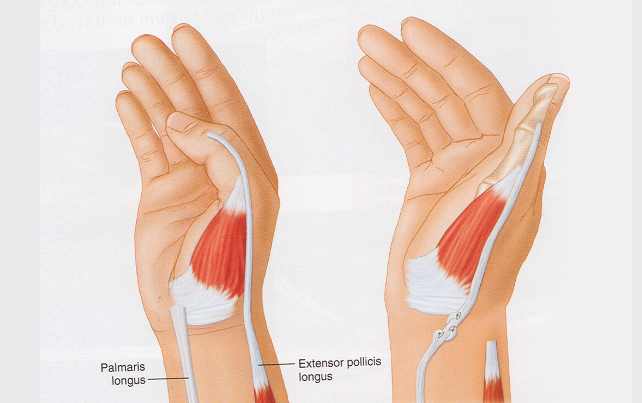 Brachial Plexus Surgery