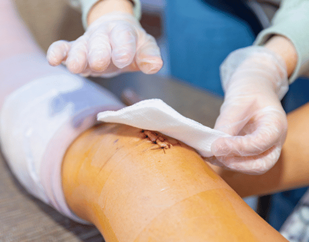 Complex Wound Management