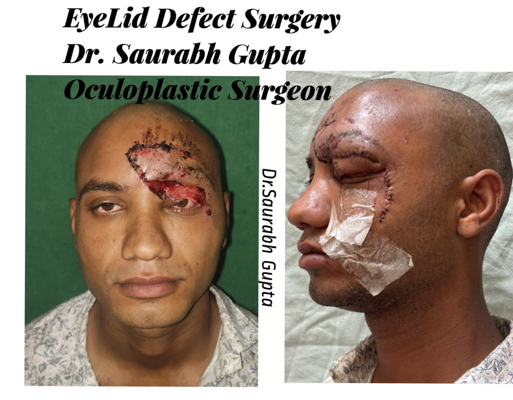 Eyelid Surgery