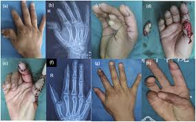Finger Reconstruction Surgery