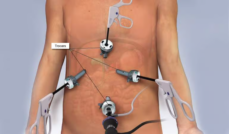 Gallbladder Stone Surgery