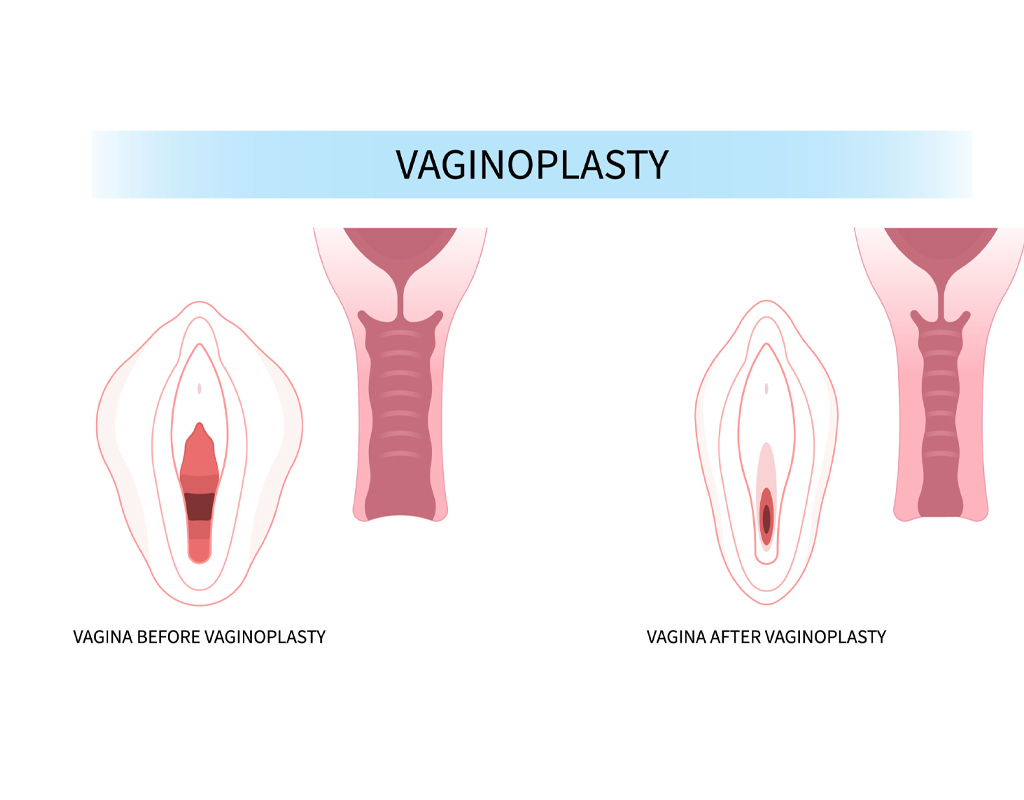 Gyne Vaginoplasty Surgery