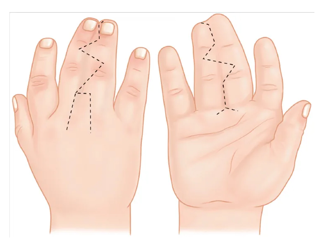 Corneal Nerve Surgery