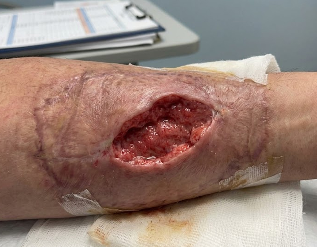 Wound Defects Treatment